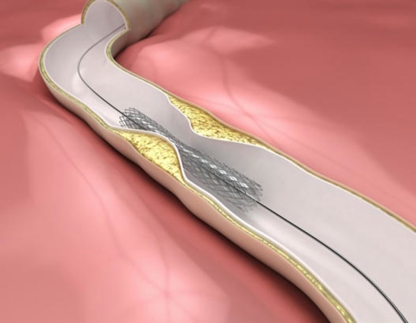 Sirolimus-eluting balloon emerges as a safe and effective option for coronary in-stent restenosis | Interventional Cardiology | Scoop.it