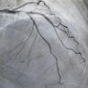 Neurovascular Intervention