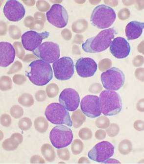 Immune system development linked to leukemia | Immunopathology & Immunotherapy | Scoop.it
