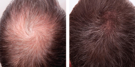 How To Get Thick And Dense Hairs Hair Transpl