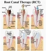 Root Canal Treatment | News | Dentagama | Daily Magazine | Scoop.it