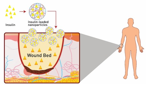 Nanocarrier-Mediated Topical Insulin Delivery for Wound Healing | iBB | Scoop.it