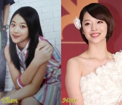 Sulli Choi f(x) Plastic Surgery Before And Afte...