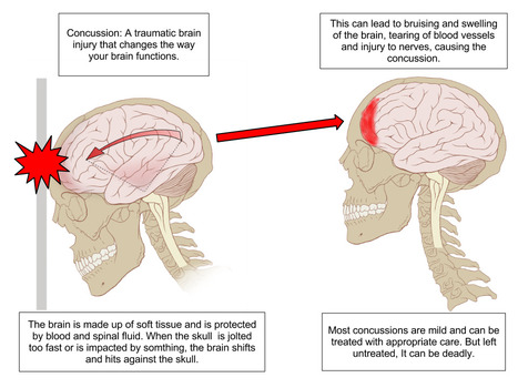 Chiropractor Treating Concussions for Earlier Return to Play | Accidents and Injuries | Scoop.it