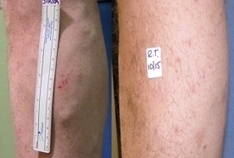 Best Vein Doctor in NJ | Veins Treatment Morris County | Medical and Health | Scoop.it