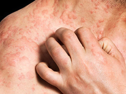 Anti-IgE Drug Scratches Itch of Chronic Hives - MedPage Today | Allergy (and clinical immunology) | Scoop.it
