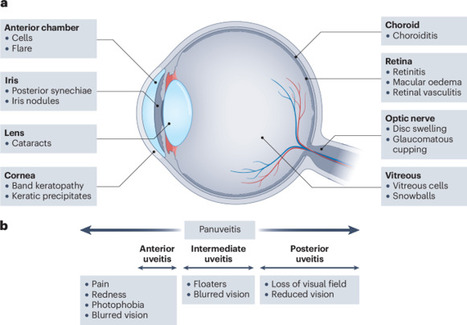The management of adult and paediatric uveitis for rheumatologists | Nature Reviews Rheumatology | Rheumatology-Rhumatologie | Scoop.it