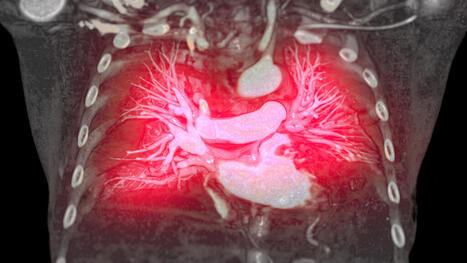 Marc Humbert, invité de RFI dans l’émission « Priorité Santé » : Hypertension artérielle pulmonaire: avancée importante dans la prise en charge de cette maladie rare | Life Sciences Université Paris-Saclay | Scoop.it