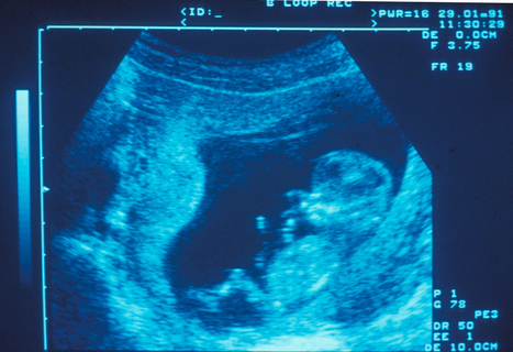 Réalisation d’une greffe in utero de cellules souches hématopoïétiques chez un fœtus atteint de déficit immunitaire combiné sévère | Bioéthique & Procréation | Scoop.it