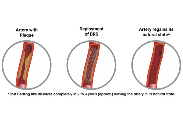 From plumbers to vascular restorers: has the Promethean promise of bioresorbable coronary scaffolds yet to be fulfilled? | Interventional Cardiology | Scoop.it