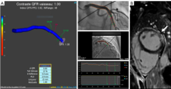 Diagnostic relevance of angiography-derived coronary microcirculatory resistance in sudden cardiac death&nbsp; | Interventional Cardiology | Scoop.it