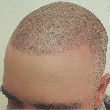 Hair Tattoo For Bald Hairline Inc Scoop It