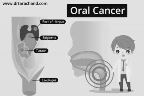 Oral Cancer Treatment in Jaipur by Dr.Tara Chand | Medical Oncologist | Cancer Treatment and Cancer therapies | Scoop.it