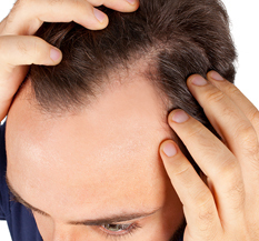 Hair Loss Treatments For Men And Women Scoop It