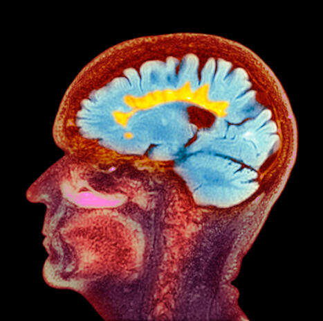 Pourquoi la sclérose en plaque touche-t-elle surtout les femmes ? | Multiple sclerosis | Scoop.it