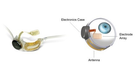 Argus II becomes first "bionic eye" to gain approval for sale in U.S. | Longevity science | Scoop.it