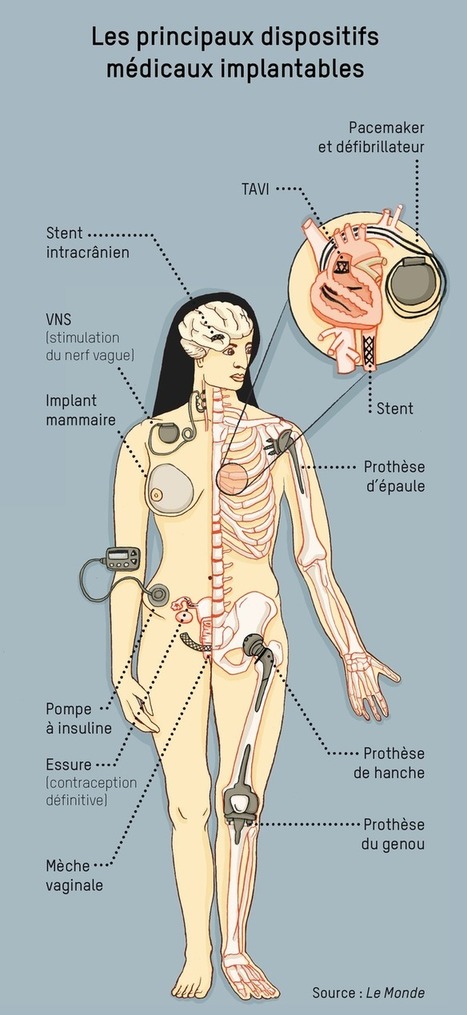 5,4 millions d'incidents en dix ans aux Etas-Unis. « Implants Files » : les 10 implants qui ont causé le plus d’incidents | Disease mongering | Scoop.it