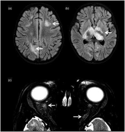 Clinical and neuroimaging findings in MOGAD–MRI and OCT - Bartels - - Clinical & Experimental Immunology | AntiNMDA | Scoop.it