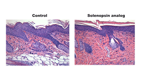 Psoriasis : un remède trouvé grâce à la fourmi de feu ? | EntomoNews | Scoop.it