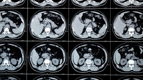 Alibaba d&eacute;voile deux IA r&eacute;volutionnaires capables de d&eacute;tecter des cancers sur de simples scanners | Intelligence artificielle | Scoop.it