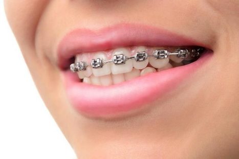 Important Points About Braces Garden State Or