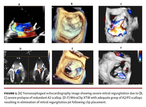 Transcatheter Mitral Valve Repair for Severe Mitral Regurgitation in Down's Syndrome | Transcatheter Treatment of Mitral Regurgitation | Scoop.it