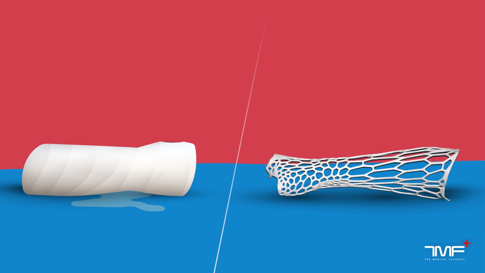 Where Are 3D-Printed Casts? | What Health