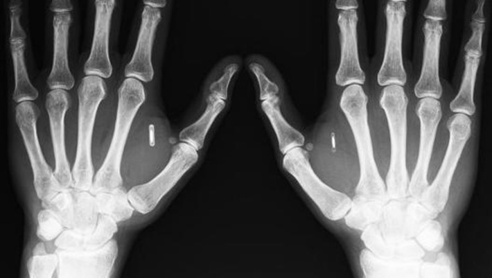 Under My Skin: The New Frontier Of Digital Implants | The Health Report | Scoop.it