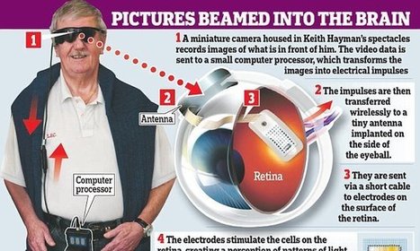 Bionic eye that restores sight to the blind is made available on NHS | Science & Transhumanisme | Scoop.it