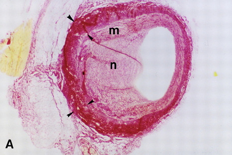 Adventitial Remodeling After Coronary Arterial Injury | Interventional Cardiology | Scoop.it