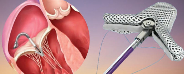 Right Ventricular Function Predicts Outcomes After PMVR | Transcatheter Treatment of Mitral Regurgitation | Scoop.it