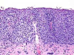 Esophagus Disease may Not be Detected by Biopsies | Allergy (and clinical immunology) | Scoop.it