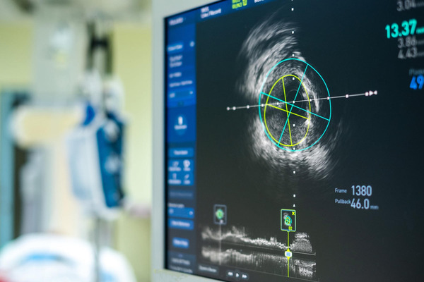 Endologix acquires thrombectomy system from Surmodics to expand offerings | Neurovascular Intervention | Scoop.it