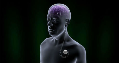 FDA Approves New Deep Brain Stimulation Device for Parkinsons | #ALS AWARENESS #LouGehrigsDisease #PARKINSONS | Scoop.it