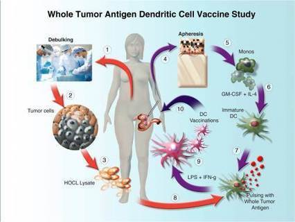 "Adoptive T-Cell" Immunotherapy Shows Activity Against Advanced Ovarian Cancer in Phase I Study | Immunology and Biotherapies | Scoop.it