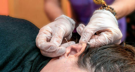 How Acupuncture Can Help With Weight Loss - EP Wellness & Functional Medicine Clinic | Call: 915-850-0900 or 915-412-6677 | Functional Medicine "Advancing The Medical Health Model" | Scoop.it