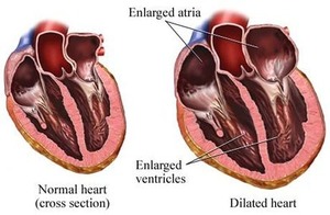 What Are The Signs Of Mitral Valve Prolapse Illness And Also What Exactly Are The Treatments For This Illness? | Transcatheter Treatment of Mitral Regurgitation | Scoop.it