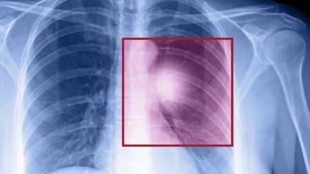 Lung cancer breathalyzer to be trialed at UK pharmacies | Critical Limb-Threatening Ischemia (CLTI) | Scoop.it