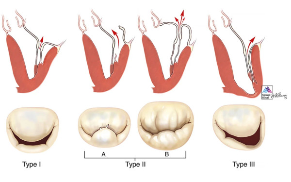 Degenerative mitral regurgitation | Transcatheter Treatment of Mitral Regurgitation | Scoop.it