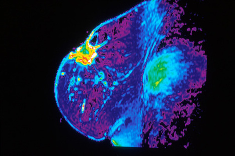 Breast Cancer Switchbacks: Spontaneous changes between HER2-positive and HER2-negative states may aid tumor growth | Social marketing - Health Promotion | Scoop.it
