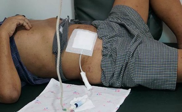 Peritoneal Dialysis Boon For Kidney Patients In COVID Times | Peritoneal dialysis | Scoop.it