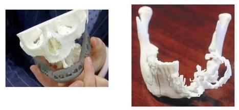 Two South African Cancer Patients Receive 3D Printed Titanium Jaw Implants | 21st Century Innovative Technologies and Developments as also discoveries, curiosity ( insolite)... | Scoop.it