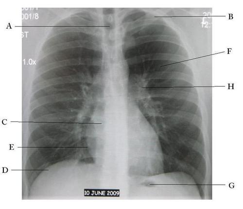 (EN) – How to Read a Chest X Ray | wikihow.com – 📚 Glossarissimo!