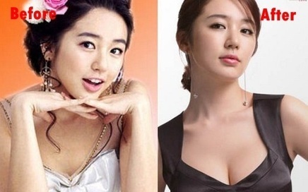 Yoon Eun Hye Plastic Surgery Before And After