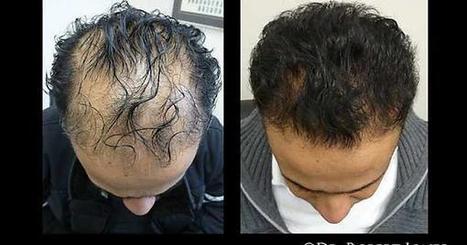 Prp Treatment For Hair Loss Dr Robert Jones