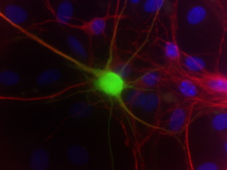 Toxin from Brain Cells Triggers Neuron Loss in Human ALS Model - Columbia University Medical Center | #ALS AWARENESS #LouGehrigsDisease #PARKINSONS | Scoop.it