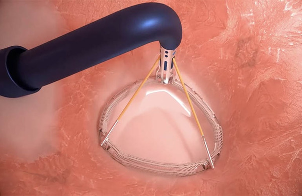 Valcare Medical Announces First U.S. Transseptal AMEND&trade; Implant in Early Feasibility Study | Transcatheter Treatment of Mitral Regurgitation | Scoop.it