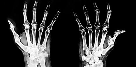 What’s the difference between osteoarthritis and rheumatoid arthritis? | Hospitals and Healthcare | Scoop.it