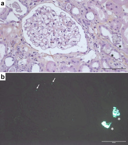 ICP science -&nbsp;Unveiling glomerular gold in oxalate nephropathy - Nephrology Image | Infos Lab' novembre 2025 | Scoop.it