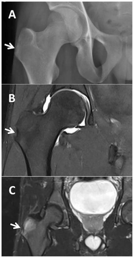 Enthesitis | Rheumatology-Rhumatologie | Scoop.it